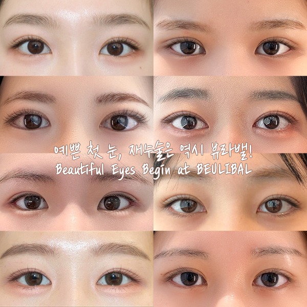 여자 눈성형 (Eye Surgery)