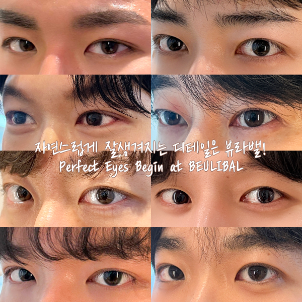 남자 눈성형 (Eye Surgery)